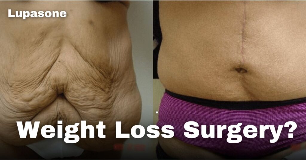 Weight Loss Surgery